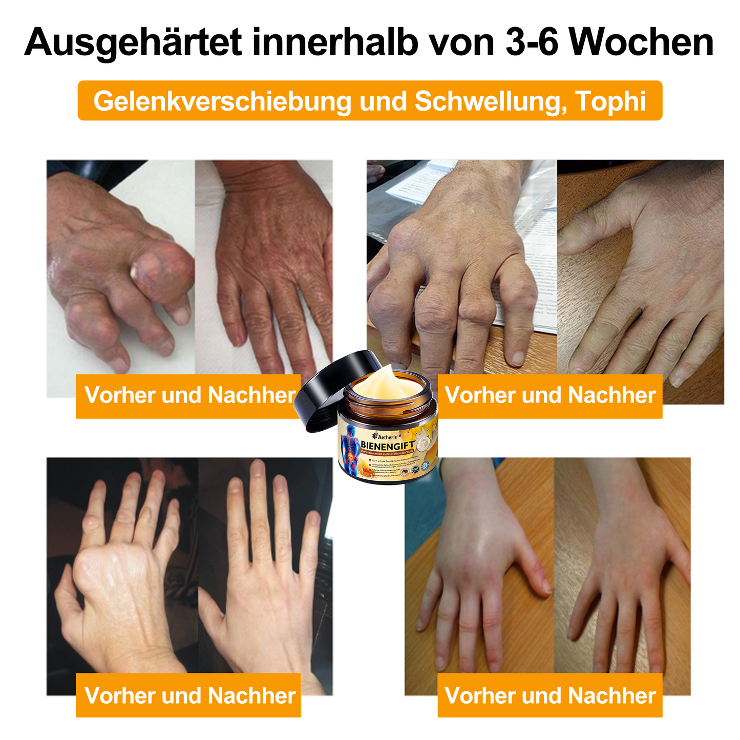 Offizieller Shop: 🔆🔆Aetheris™ Bienengift Sofortige Ultra Starke Schmerztherapie-Creme - (Bietet Schmerzlinderung bei Arthritis, Muskel-, Rücken-, Knie-, Schulter-, Hüft-, Handgelenks- und Handschmerzen)